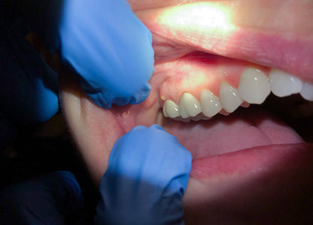 Best Urgent Tooth Repair  in Headland, AL